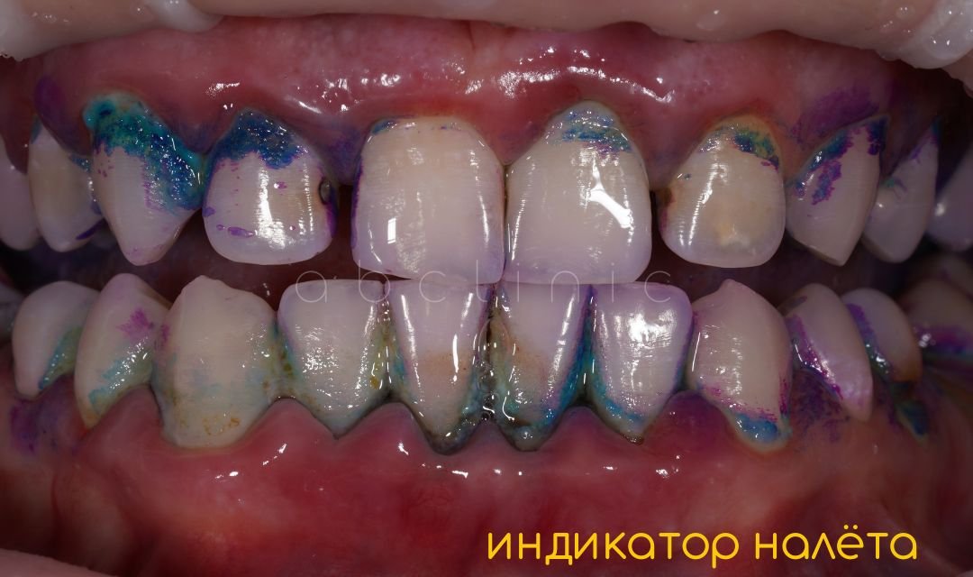 Что такое GBT и чем профессиональная гигиена отличается от обычной чистки
